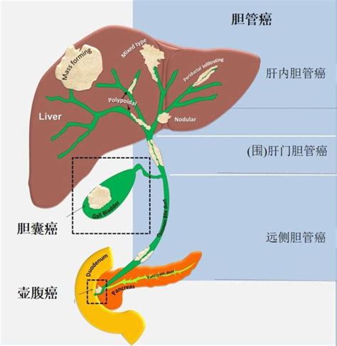 急性梗阻性化脓性胆管【多图】_39医疗图集-39健康网