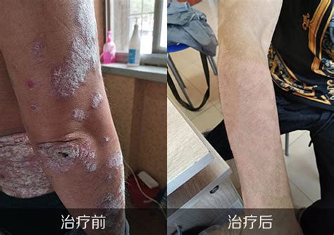 银屑病治疗前后对比图片怎么治疗能好-中华银屑病网