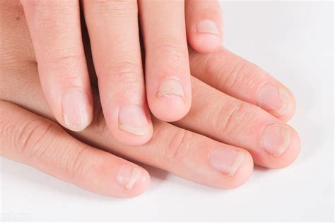 轻微灰指甲初期怎么治（灰指甲如何预防？如何治疗？医生：记住这几点，控好灰指甲） | 说明书网