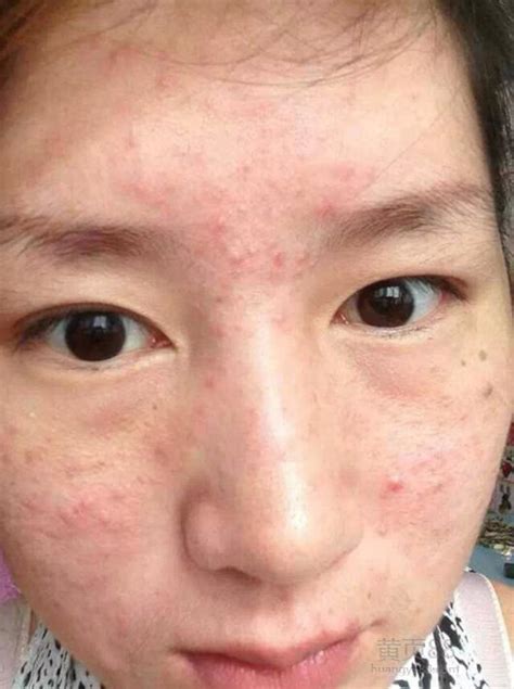 丘疹和症状图片