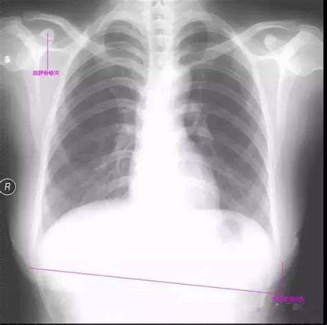 AI再出力，可通过胸部X光片检测新冠 - 科技行者