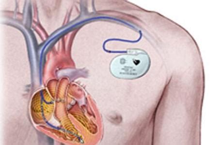 3D动画：心脏起搏器植入手术全过程_腾讯视频