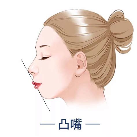 轻微嘴歪图片