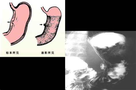 多图了解胃肠道的正常表现和基本病变_胃肠道_病变表现_钡剂检查_医脉通