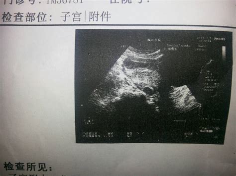 请问下下面是两个月的怀孕B超，孕囊是哪个？能看出是长形的还是圆形的吗？ - 百度宝宝知道