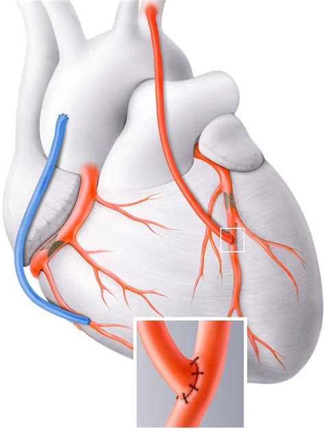 Bypass Surgery (Coronary Heart Diseases)