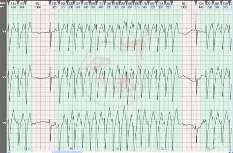 心电图图例分析：阵发性室性心动过速 - 爱爱医医学网