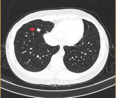 肺结节读片(21)：鉴别11mm的实性结节良恶性的技巧 - 微医（挂号网）