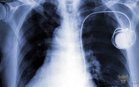 植入式心脏起搏器Qinming 8631DR – 乐普医电