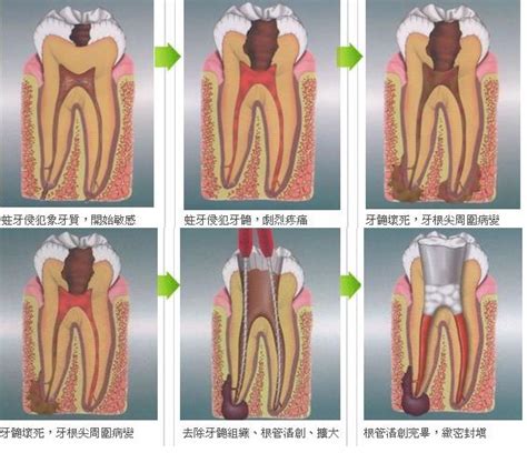 牙科根管治疗收费价目表,门牙根管治疗500+/后牙根管一次1000+,牙齿修复-8682赴韩整形网