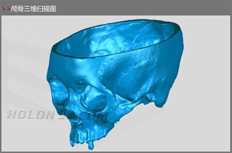 颅骨三维扫描案例