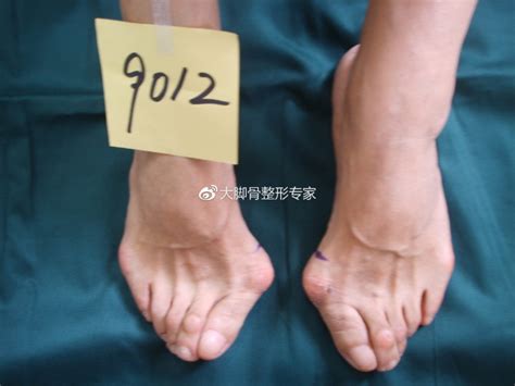 “大脚骨”就是脚骨变大了吗？|北京德尔康尼骨科医院-北京德尔康尼骨科医院
