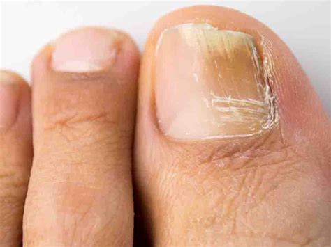 在家治疗灰指甲，教你一个方法，灰指甲再不复发|灰指甲|癣菌|尿素_新浪新闻