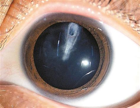 【眼球突出怎么恢复窍门】【图】眼球突出怎么恢复窍门有哪些 几种方法恢复漂亮眼睛(2)_伊秀健康|yxlady.com