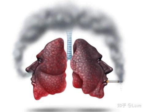 例8 周围型肺癌-呼吸系统-医学