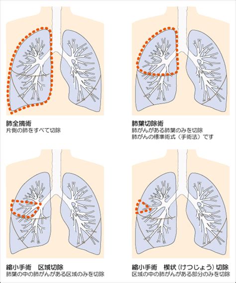 手术治疗肺癌的类型有哪些？分析肺癌治疗的四种常见手术方式-厚朴方舟