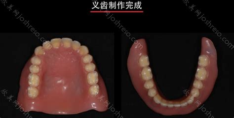 全口义齿图片