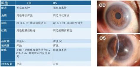 梁远波教授：我国创新的穿透性粘小管成形术治疗青光眼的新研究_手术_眼压_传统