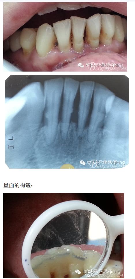 牙周夹板固定图片