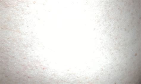 【胸口长红疙瘩是艾滋病】【图】胸口长红疙瘩是艾滋病吗 艾滋病的症状及预防你知道吗(2)_伊秀健康|yxlady.com