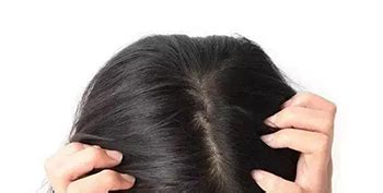 哪种植发项目是针对头发稀疏问题的，头发加密手术怎么收费呢 - 知乎