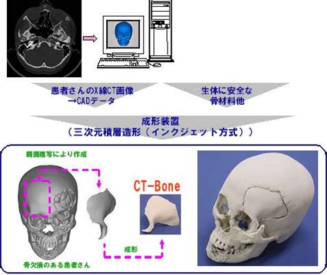 世界首例3D打印可降解人工骨修复长段骨缺损 - 3D科学谷