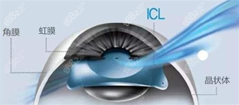 ICL晶体植入手术演示