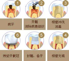 根管治疗的哪些步骤能使牙齿寿命延长？这些知识告诉你！ - 口腔资讯 - 牙齿矫正网