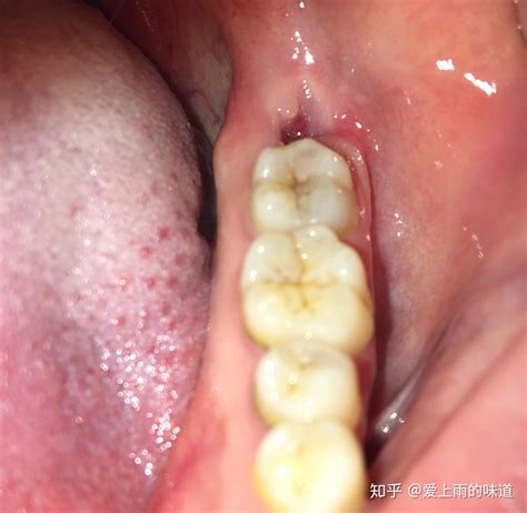 智齿没拔干净图片