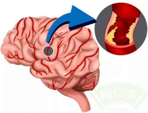 脑梗的症状都有哪些前期症状-脑梗的主要原因-脑梗的饮食禁忌有哪些