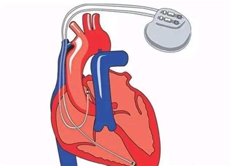 心脏起搏器的类型和参数_挂云帆