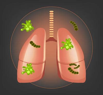 肺部感染人体模型图片素材-正版创意图片401907176-摄图网