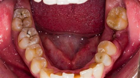 智慧牙发炎肿痛怎么办（"阳"了，牙龈肿痛、智齿发炎？莫慌！牙科医生教你正确处理） | 说明书网