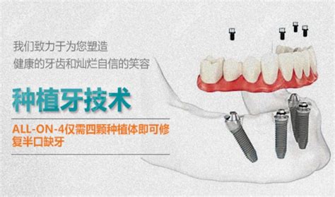 2022全国种植牙价格表一览，种一颗牙价格4000,6000,10000都有,种植牙-8682赴韩整形网