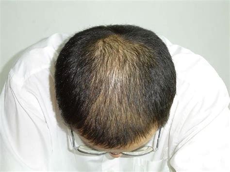 脂溢性脱发怎么治疗效果好?治疗脂溢性脱发的关键在这里 - 知乎