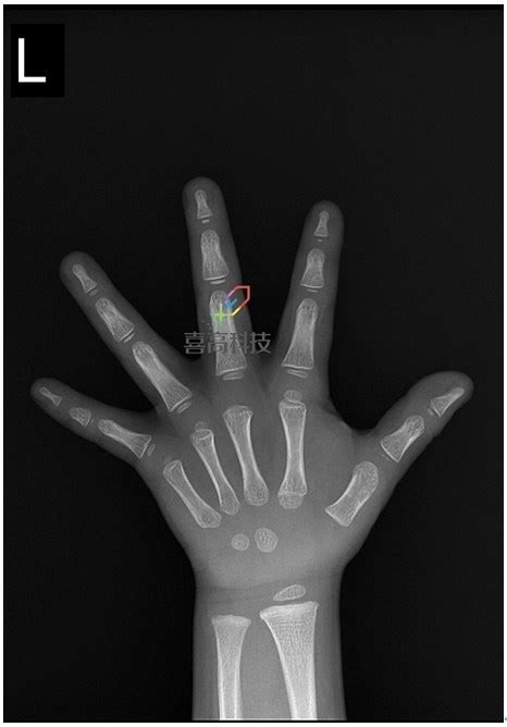 【中华05标准】读准X光骨龄片最基础知识解析 - 重庆展望未来骨龄检测科研所
