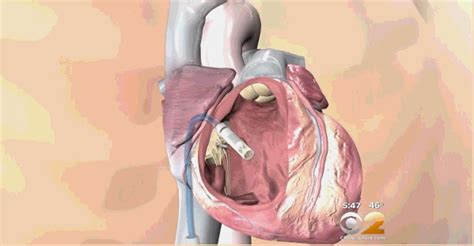 先健科技心脏起搏电极导线获CFDA批准上市