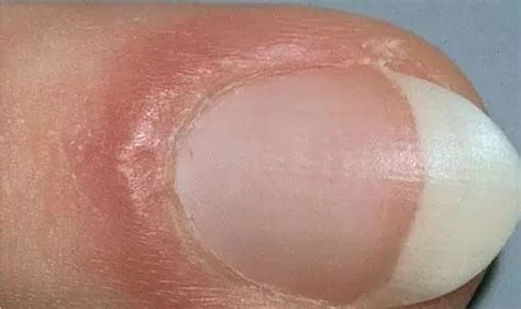 指甲断裂 是什么原因