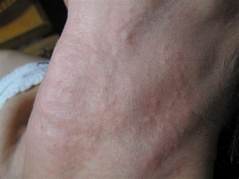 荨麻疹的有效治疗方法是什么_北京京城皮肤医院(北京医保定点机构)_ 皮肤病大全