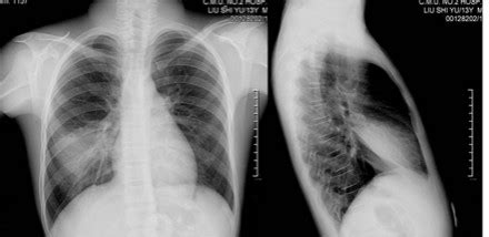 肺部有阴影一定是肺癌吗，肺部有阴影可能是哪些疾病！