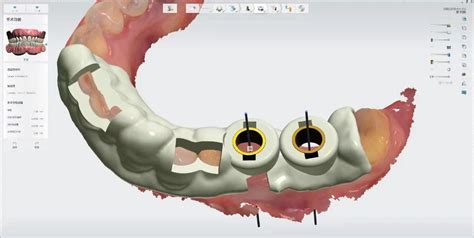 3shape设计牙齿-数字印模-口内扫描仪_口内扫描仪_武汉易成三维科技有限公司