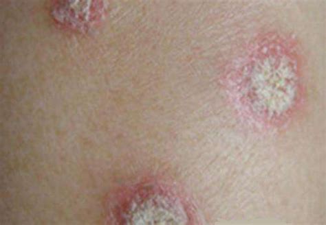 湿疹是怎么引起的-湿疹病因-复禾健康