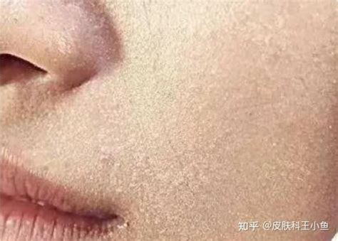 脸部癜风图片