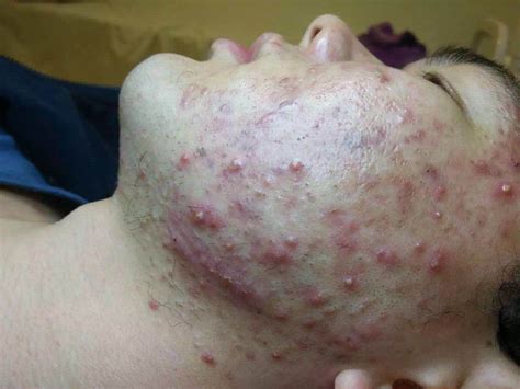 皮肤长鸡皮疙瘩是怎么回事（皮肤长鸡皮疙瘩是怎么回事儿）