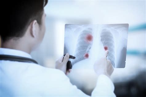 肺结核治疗的三大难点解析 | 科普资讯 | 运城安国中医结核病医院
