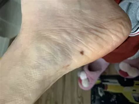 大腿上有痣图解图片