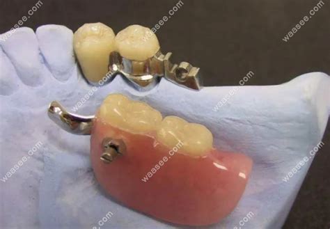不伤邻牙的镶牙新方法：种植牙、无挂钩假牙技术比较先进 - 口腔资讯 - 牙齿矫正网