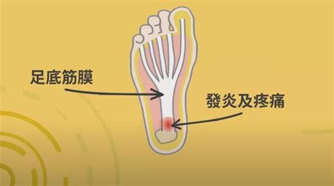 脚底板痛是怎么回事？应该如何缓解？|脚底板|筋膜炎|脚掌_新浪新闻