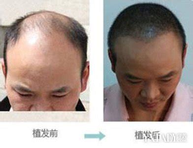 植发的效果能保持多久，植发有危害么？ – 生发垂直网