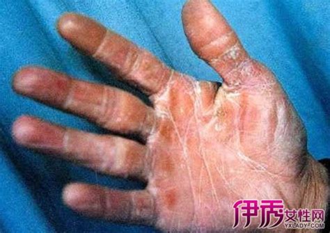 角化型手足癣图片